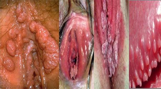 Illustration for article titled Cara Mengobati benjolan daging Di Kepala Penis